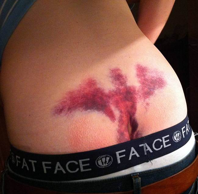 Chris Holland saved on stag night by ‘guardian angel who appears as a bruise on his buttocks’ (Pareidolia)