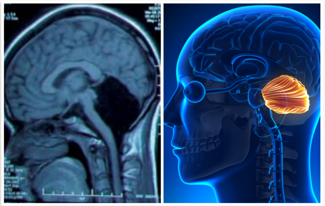 Woman found functioning without a cerebellum in her brain